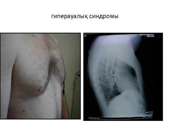 гиперауалық синдромы 