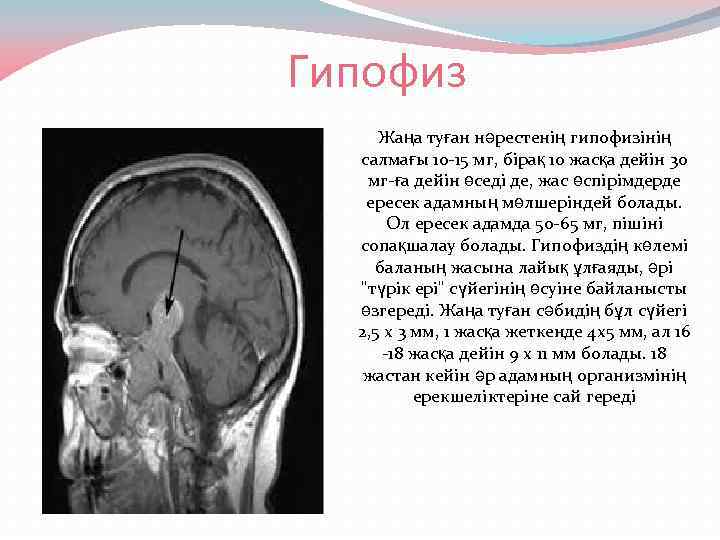 Гипофиз Жаңа туған нәрестенің гипофизінің салмағы 10 -15 мг, бірақ 10 жасқа дейін 30