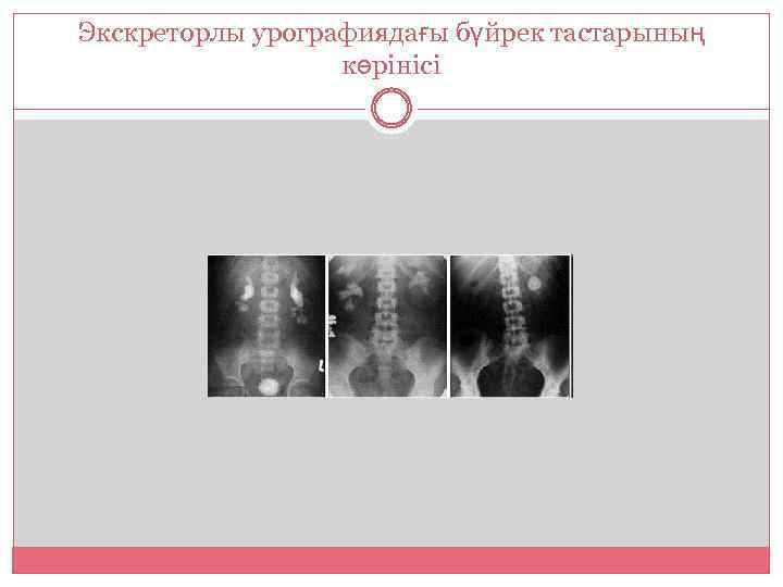 Экскреторлы урографиядағы бүйрек тастарының көрінісі 