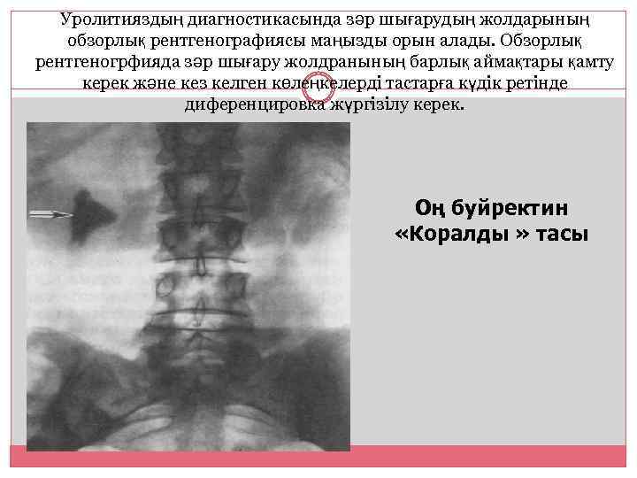 Уролитияздың диагностикасында зәр шығарудың жолдарының обзорлық рентгенографиясы маңызды орын алады. Обзорлық рентгеногрфияда зәр шығару