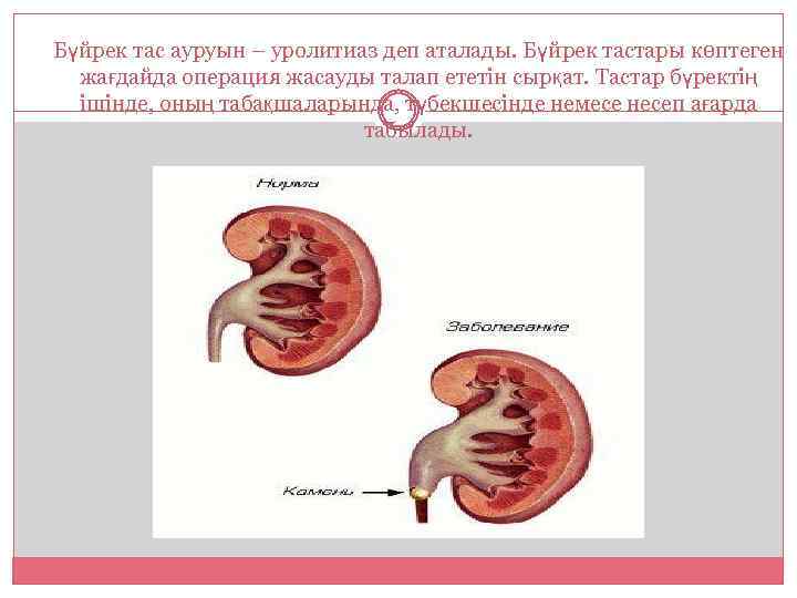 Бүйрек тас ауруын – уролитиаз деп аталады. Бүйрек тастары көптеген жағдайда операция жасауды талап