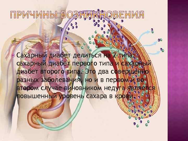  Сахарный диабет делиться на 2 типа: сахарный диабет первого типа и сахарный диабет