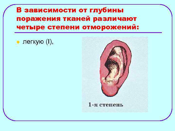 В зависимости от глубины поражения тканей различают четыре степени отморожений: l легкую (I), 