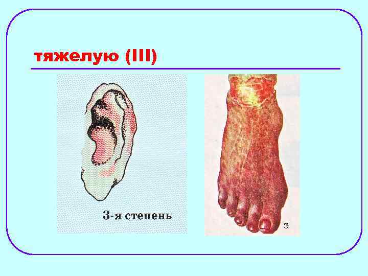 тяжелую (III) 