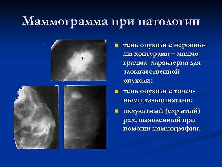 Маммография уплотнения. Маммография патологические кальцинаты. Маммография молочных желез объемное образование. Онкология на маммографии. Маммография патологическая тень.