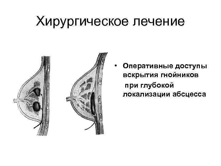 Хирургическое лечение • Оперативные доступы вскрытия гнойников при глубокой локализации абсцесса 