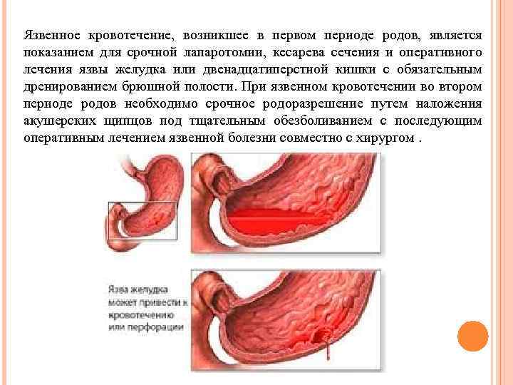 Язвенное кровотечение, возникшее в первом периоде родов, является показанием для срочной лапаротомии, кесарева сечения