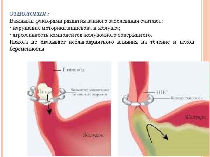 ЭТИОЛОГИЯ : Важными факторами развития данного заболевания считают: · нарушение моторики пищевода и желудка;