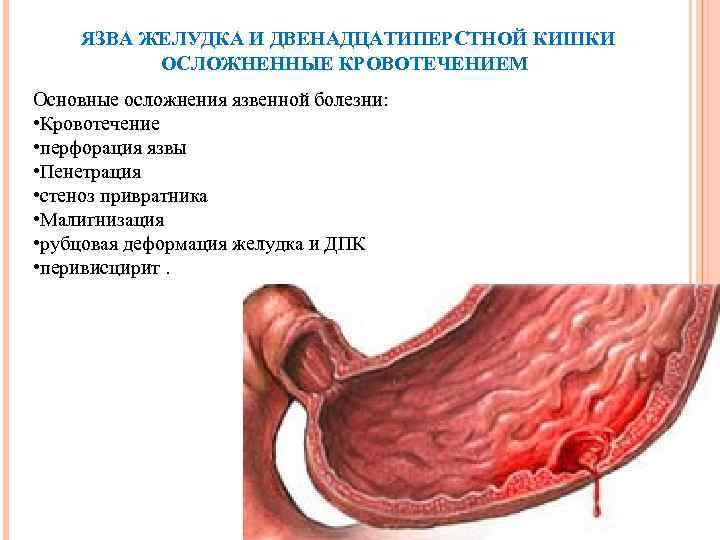 ЯЗВА ЖЕЛУДКА И ДВЕНАДЦАТИПЕРСТНОЙ КИШКИ ОСЛОЖНЕННЫЕ КРОВОТЕЧЕНИЕМ Основные осложнения язвенной болезни: • Кровотечение •