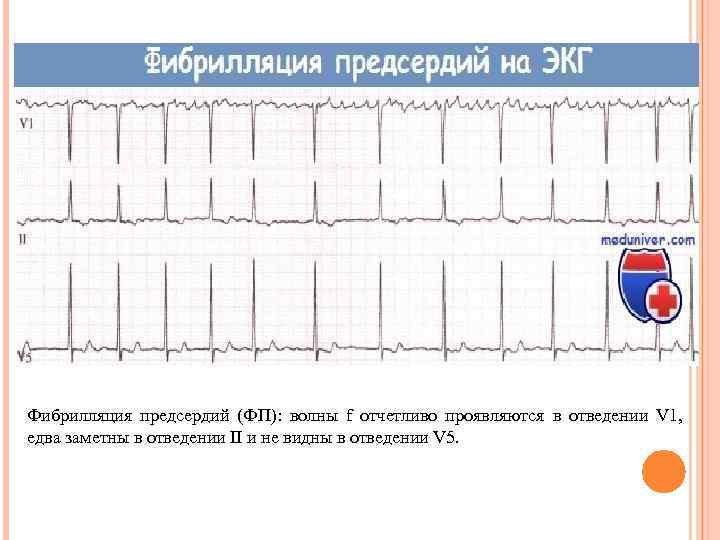Фибрилляция предсердий (ФП): волны f отчетливо проявляются в отведении V 1, едва заметны в