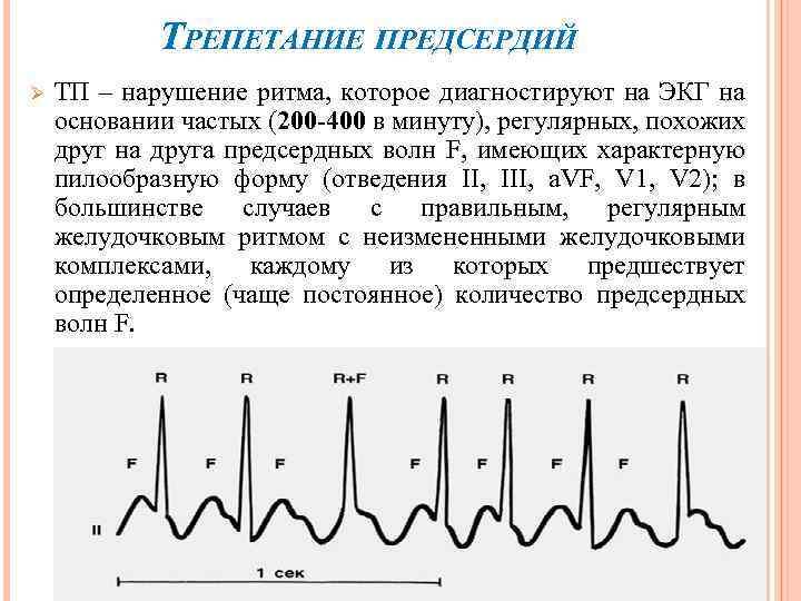ТРЕПЕТАНИЕ ПРЕДСЕРДИЙ Ø ТП – нарушение ритма, которое диагностируют на ЭКГ на основании частых