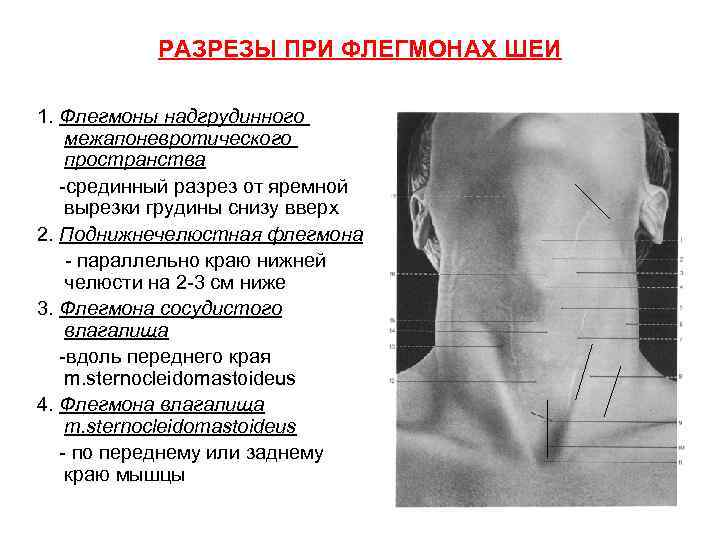 РАЗРЕЗЫ ПРИ ФЛЕГМОНАХ ШЕИ 1. Флегмоны надгрудинного межапоневротического пространства -срединный разрез от яремной вырезки