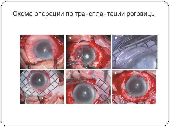 Схема операции по трансплантации роговицы 