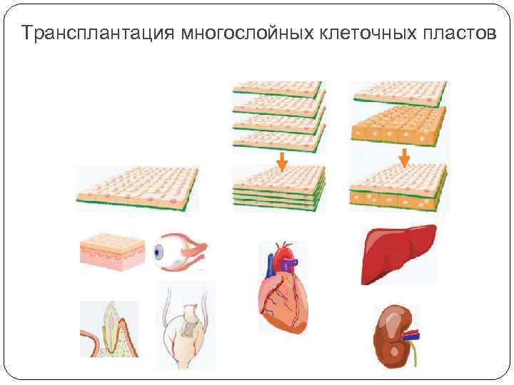 Трансплантация многослойных клеточных пластов 