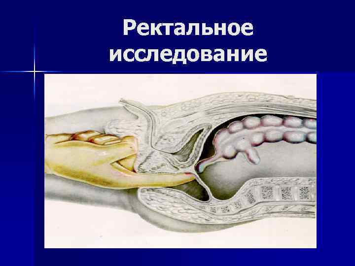 Ректальное исследование 