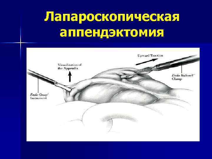 Лапароскопическая аппендэктомия 