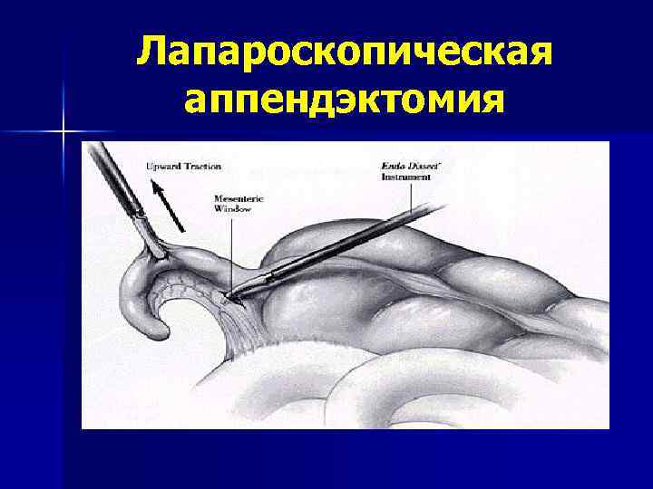 Лапароскопическая аппендэктомия 