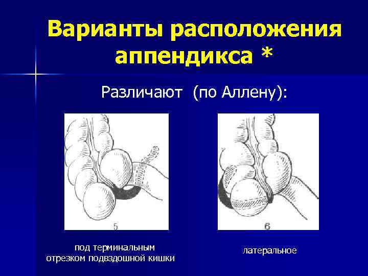 Варианты расположения аппендикса * Различают (по Аллену): под терминальным отрезком подвздошной кишки латеральное 