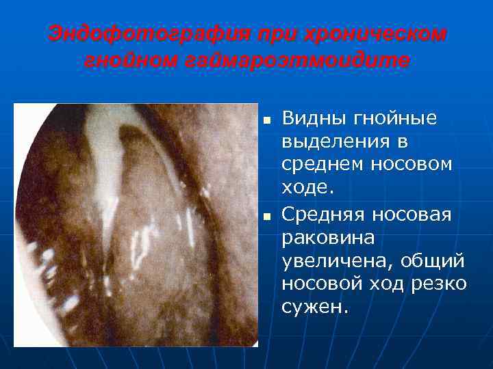 Эндофотография при хроническом гнойном гаймароэтмоидите n n Видны гнойные выделения в среднем носовом ходе.
