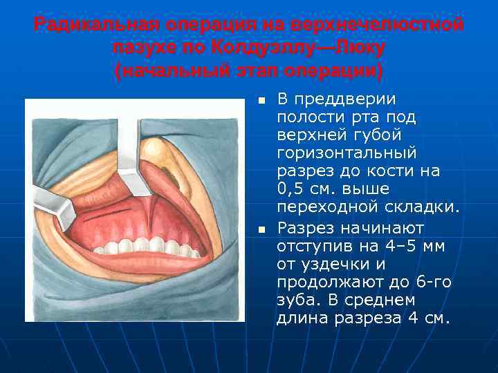 Радикальная операция на верхнечелюстной пазухе по Колдуэллу—Люку (начальный этап операции) n n В преддверии