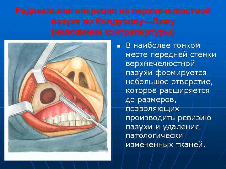 Радикальная операция на верхнечелюстной пазухе по Колдуэллу—Люку (наложение контрапертуры) n В наиболее тонком месте