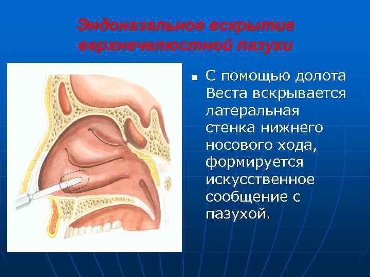 Эндоназальное вскрытие верхнечелюстной пазухи n С помощью долота Веста вскрывается латеральная стенка нижнего носового