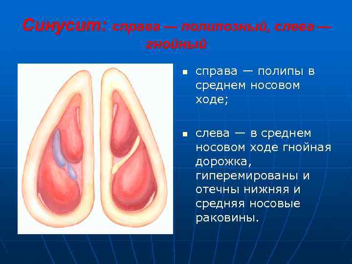 Синусит: справа — полипозный, слева — гнойный n n справа — полипы в среднем