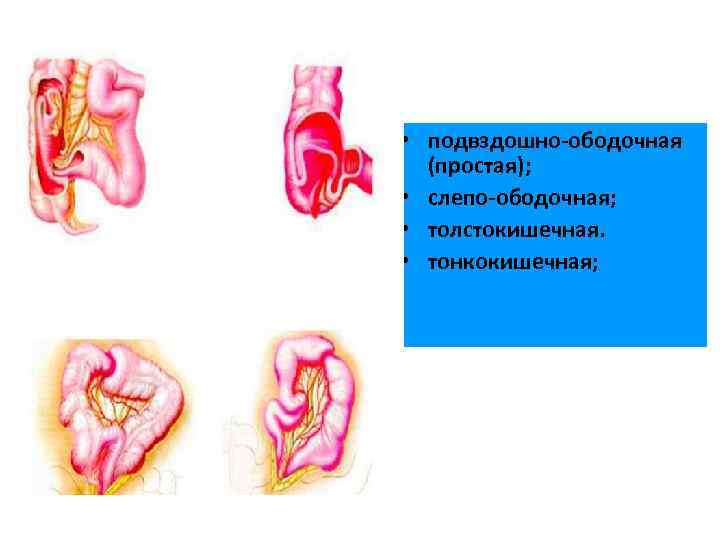 • подвздошно-ободочная (простая); • слепо-ободочная; • толстокишечная. • тонкокишечная; 