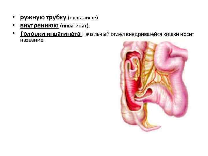  • ружную трубку (влагалище) • внутреннюю (инвагинат). • Головки инвагината Начальный отдел внедрившейся