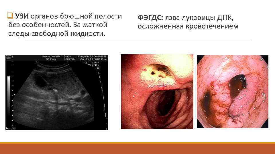 q УЗИ органов брюшной полости без особенностей. За маткой следы свободной жидкости. ФЭГДС: язва