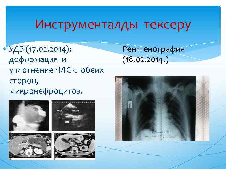 Инструменталды тексеру УДЗ (17. 02. 2014): деформация и уплотнение ЧЛС с обеих сторон, микронефроцитоз.