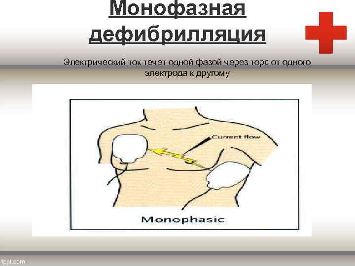 Монофазная дефибрилляция Электрический ток течет одной фазой через торс от одного электрода к другому