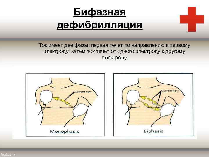 Бифазная дефибрилляция Ток имеет две фазы: первая течет по направлению к первому электроду, затем