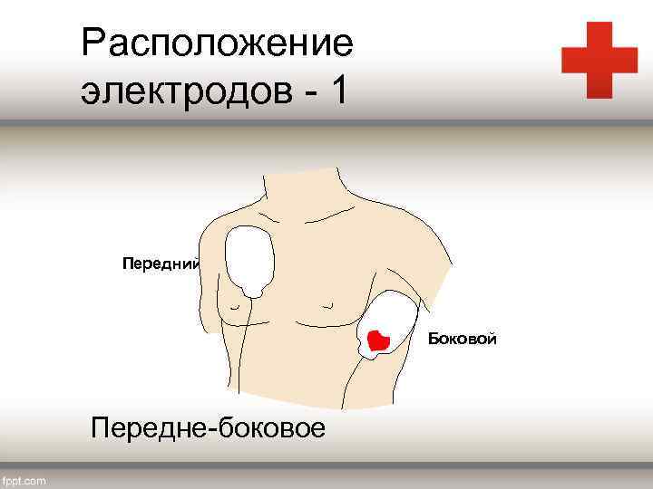 Расположение электродов - 1 Передний Боковой Передне-боковое 