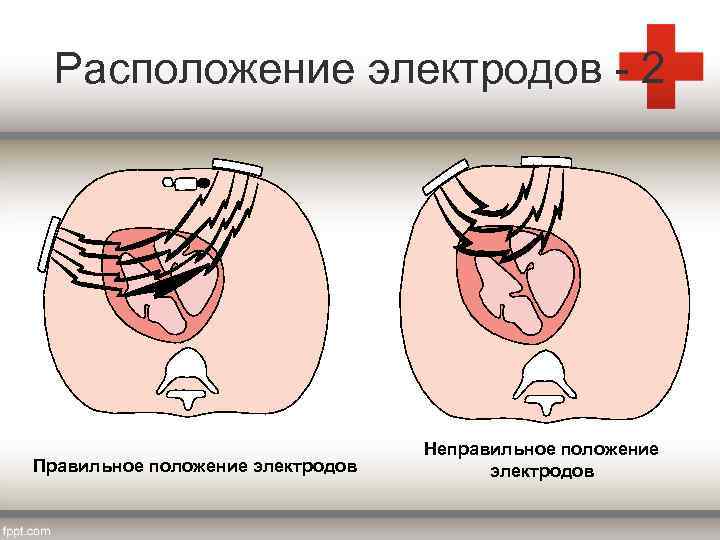 Расположение электродов - 2 Правильное положение электродов Неправильное положение электродов 