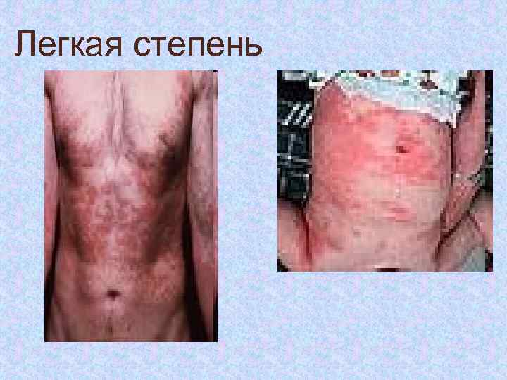 Легкая степень 