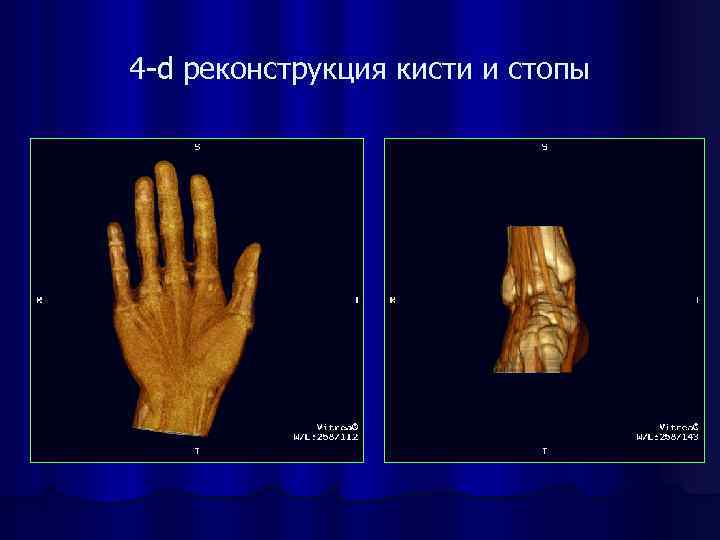 4 -d реконструкция кисти и стопы 