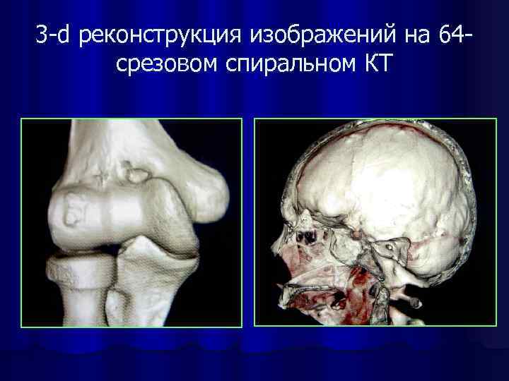 3 -d реконструкция изображений на 64 срезовом спиральном КТ 