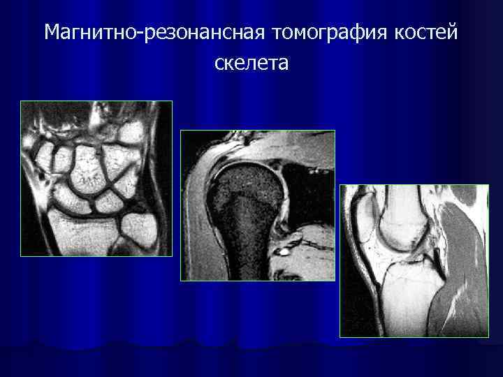 Магнитно-резонансная томография костей скелета 