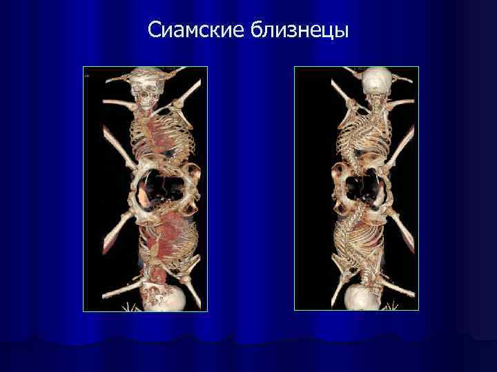 Сиамские близнецы 