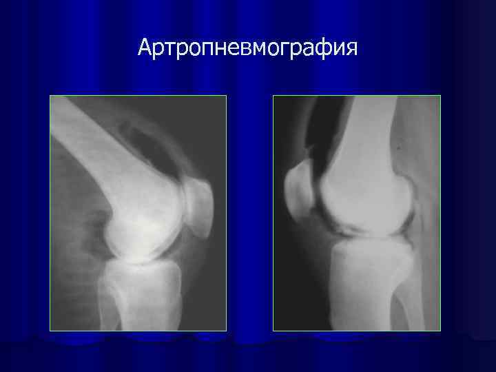 Артропневмография 