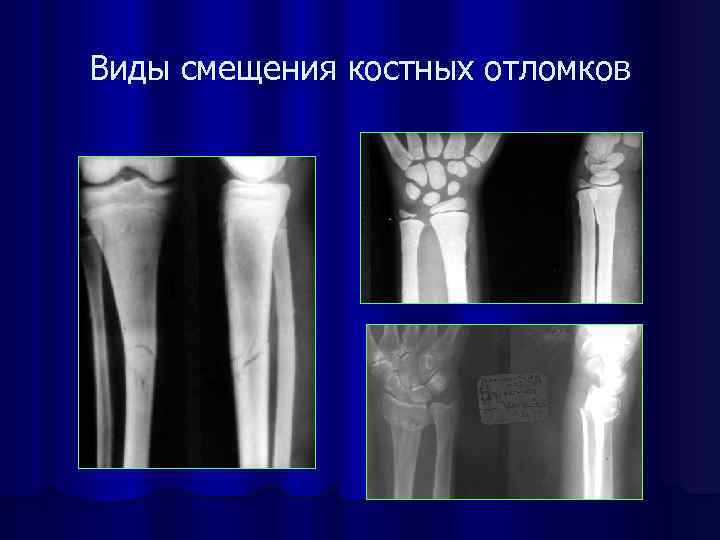 Патологическая подвижность костных отломков. Рентгенодиагностика перелом кости. Смещение костного отломка. Варианты смещения костных отломков. Смещение костного отломка.