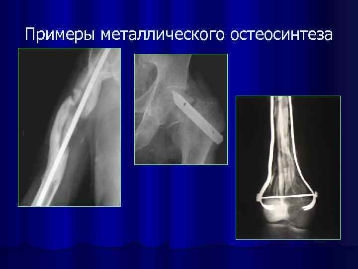Примеры металлического остеосинтеза 