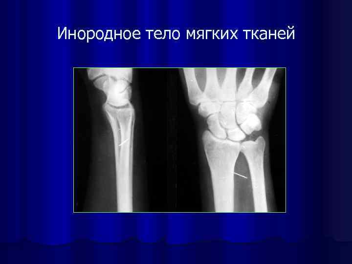 Инородное тело мягких тканей 