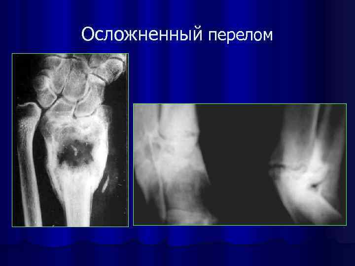 Осложненный перелом 