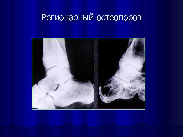 Регионарный остеопороз 
