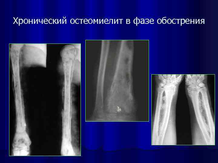 Рентгенодиагностика остеомиелита презентация