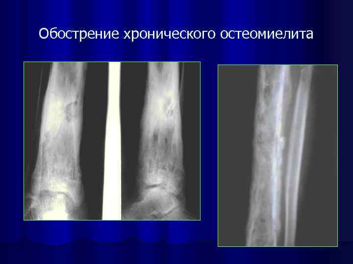 Рентгенодиагностика остеомиелита презентация