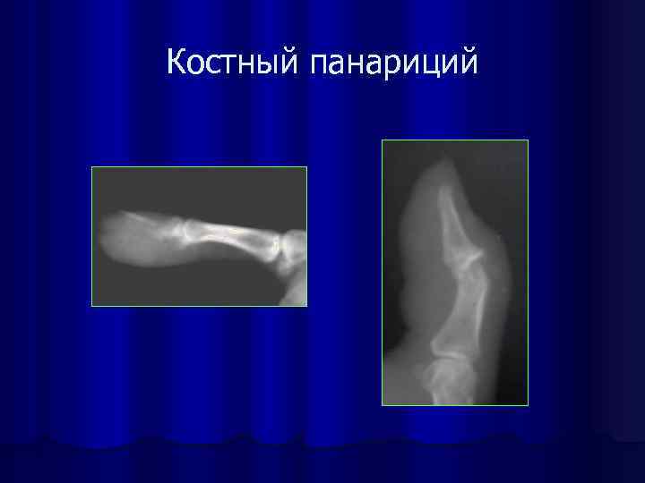 Костный панариций 
