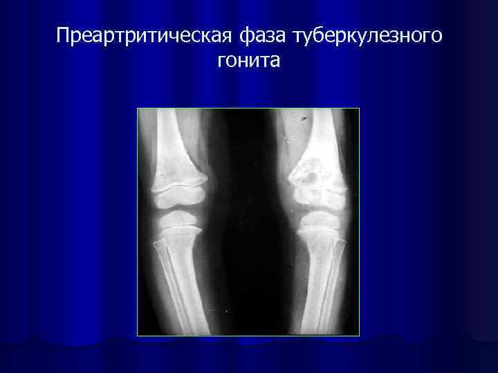 Преартритическая фаза туберкулезного гонита 